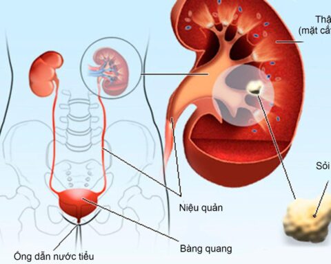 Sỏi tiết niệu ở trẻ: Phát hiện muộn có thể ảnh hưởng chức năng thận