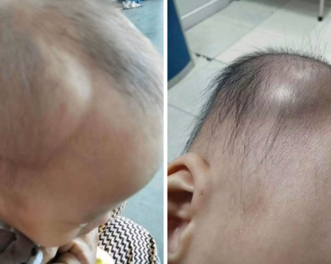 1 mẹ bỉm chia sẻ diễn biến âm thầm nhưng nguy hiểm sau cú ngã của con: Đừng chủ quan kể cả khi bé có vẻ vẫn bình thường