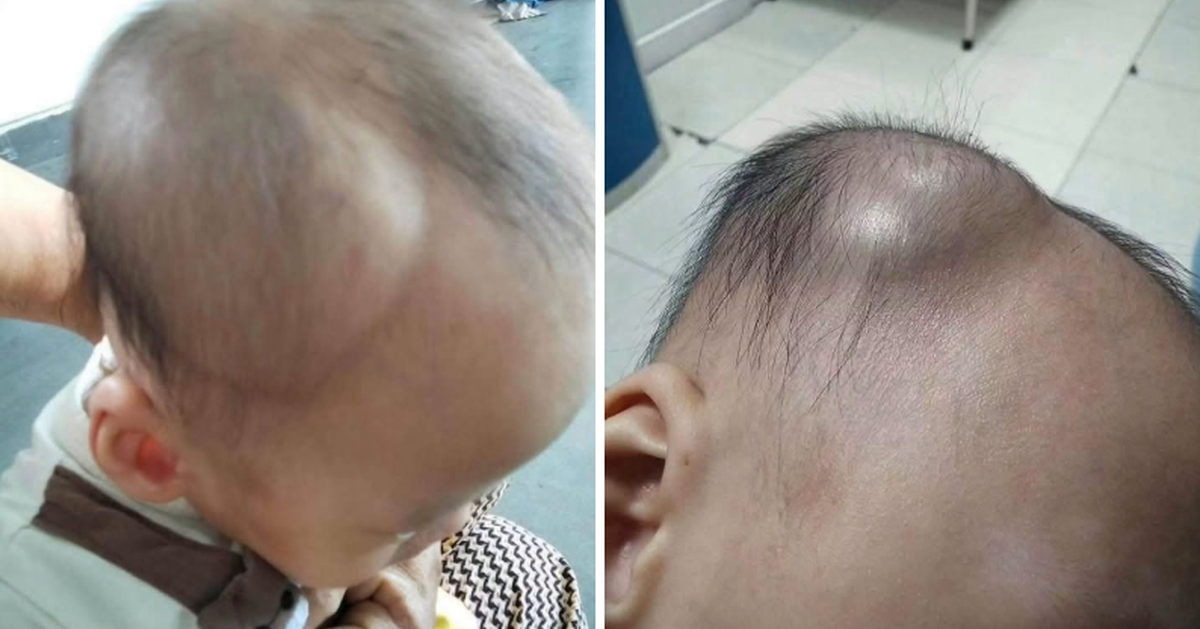 1 mẹ bỉm chia sẻ diễn biến âm thầm nhưng nguy hiểm sau cú ngã của con: Đừng chủ quan kể cả khi bé có vẻ vẫn bình thường