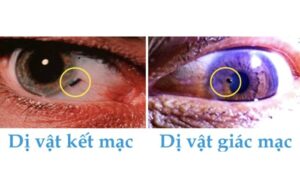 Dị vật trong mũi gây nguy hại như thế nào, cách phát hiện sớm?