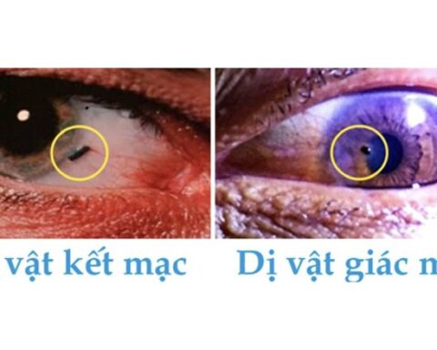 Dị vật trong mũi gây nguy hại như thế nào, cách phát hiện sớm?