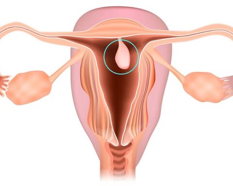 Polyp nội mạc tử cung có nguy hiểm không?