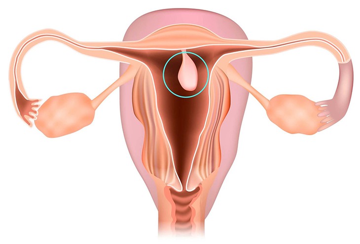 Polyp nội mạc tử cung có nguy hiểm không?