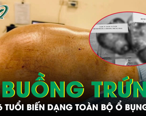 Bé gái bụng to bất thường, cảnh giác với khối u buồng trứng