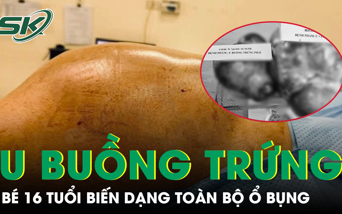 Bé gái bụng to bất thường, cảnh giác với khối u buồng trứng