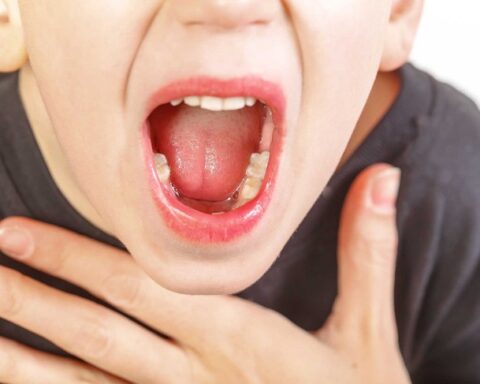 Triệu chứng viêm VA cấp tính và mạn tính ở trẻ em