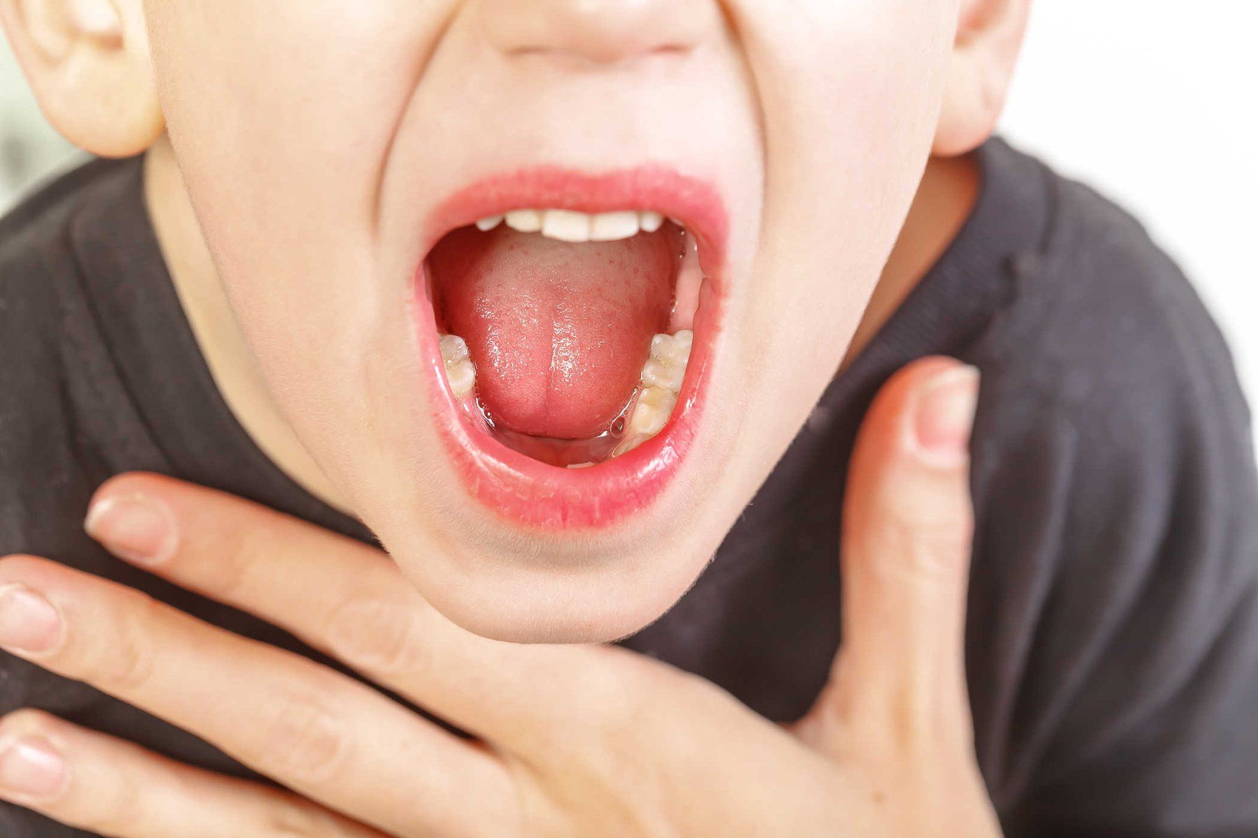 Triệu chứng viêm VA cấp tính và mạn tính ở trẻ em - Ảnh 1.