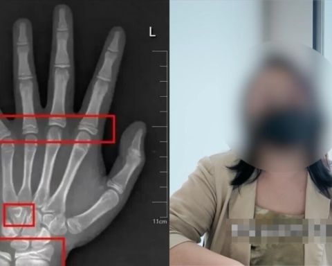 Bé gái đã có tuổi xương “chạy trước” gần 3 năm, đây là 4 sai lầm mà cha mẹ Việt thường mắc phải