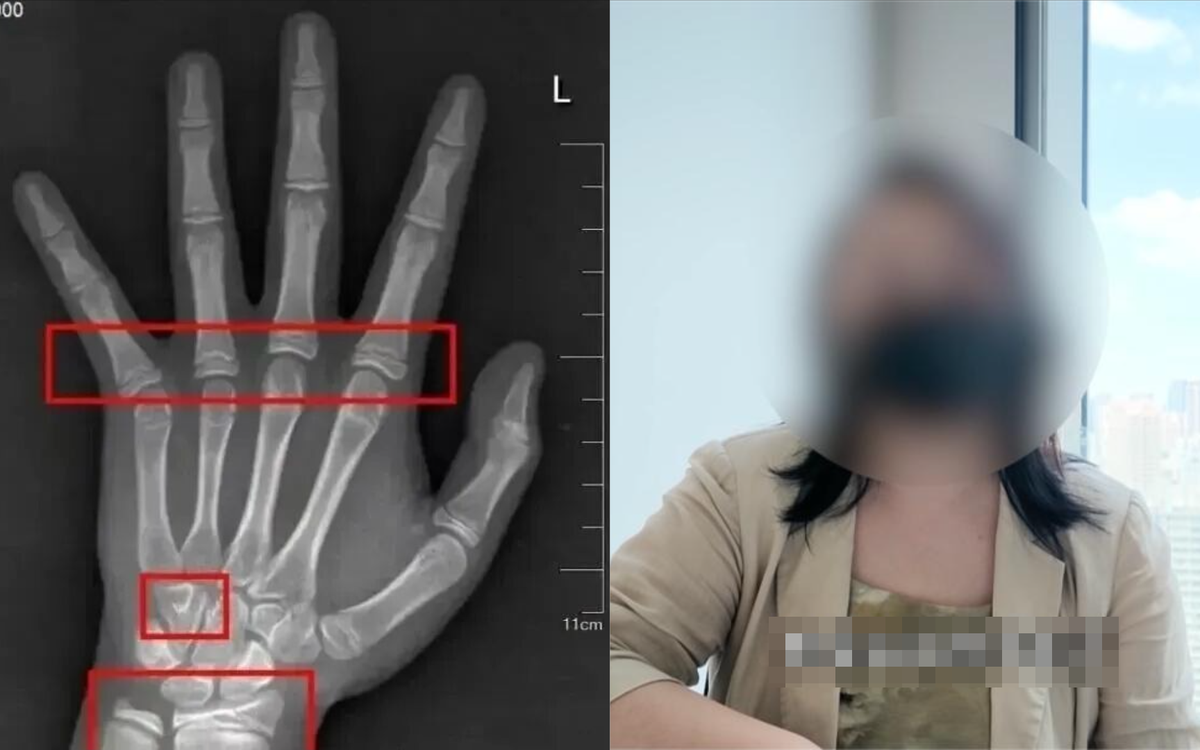 Bé gái đã có tuổi xương “chạy trước” gần 3 năm, đây là 4 sai lầm mà cha mẹ Việt thường mắc phải