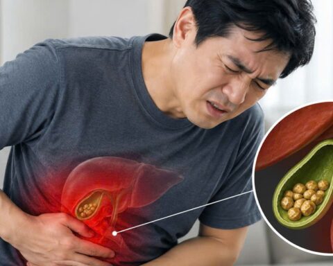 Bác sĩ chỉ 4 dấu hiệu cảnh báo sỏi mật, một dấu hiệu dễ nhận thấy sau bữa ăn