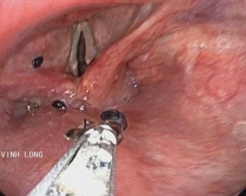 Đàn kiến chui vào thanh quản người đàn ông
