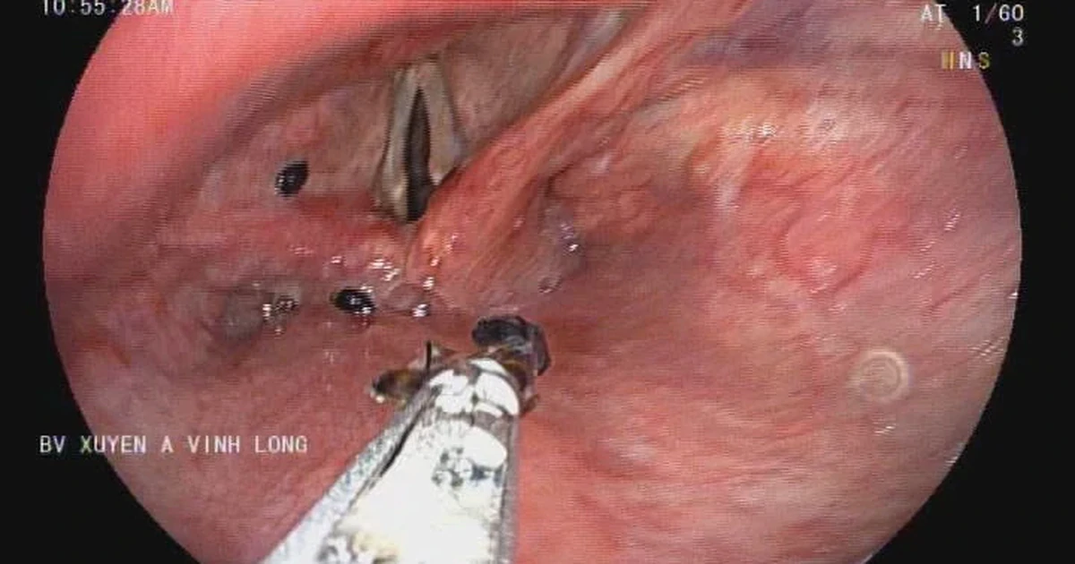 Đàn kiến chui vào thanh quản người đàn ông