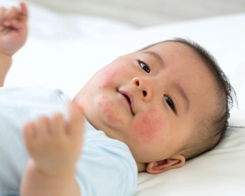 Làm sao biết con bạn bị dị ứng sữa?