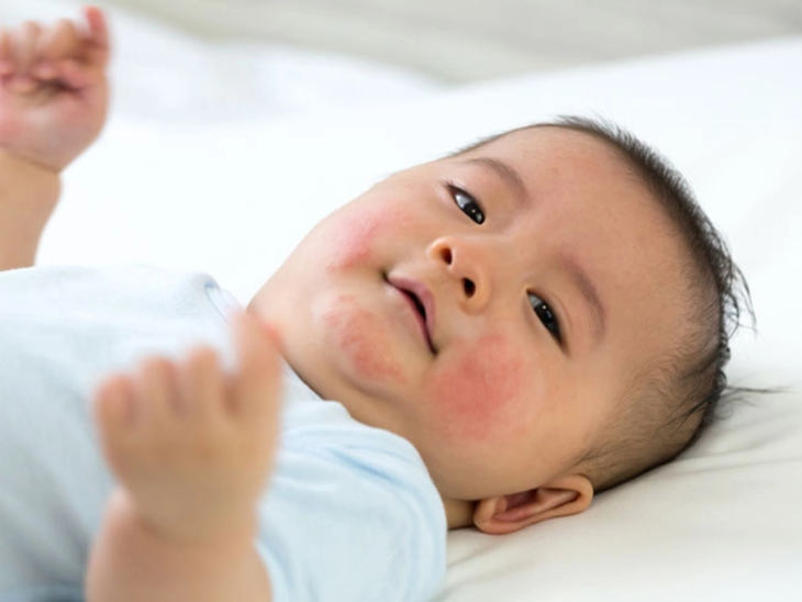 Làm sao biết con bạn bị dị ứng sữa?