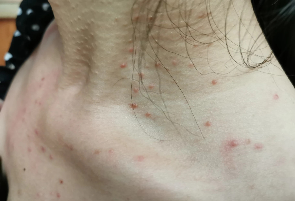 4 dấu hiệu ung thư thích "trốn" trên vùng cổ- Ảnh 1.