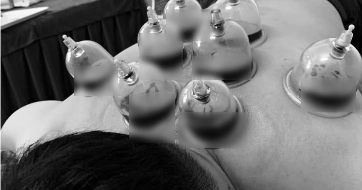 Trào lưu “chích máu chữa đột quỵ” khiến bác sĩ lạnh người