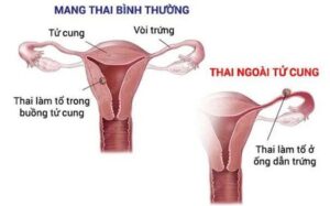 Dấu hiệu mang thai ngoài tử cung cần nhận biết sớm