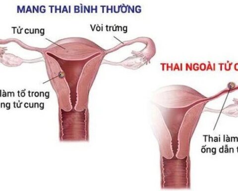 Dấu hiệu mang thai ngoài tử cung cần nhận biết sớm