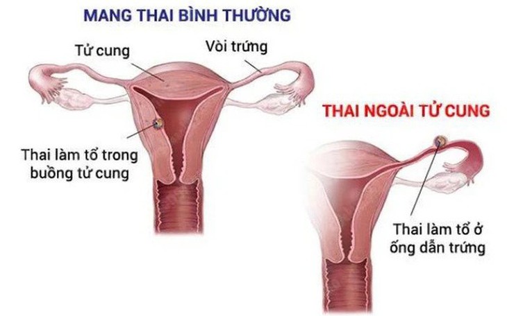 Dấu hiệu mang thai ngoài tử cung cần nhận biết sớm