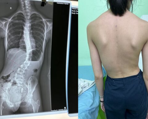 Đau cổ, đau lưng ở trẻ: Khi nào nghi ngờ cong vẹo cột sống?