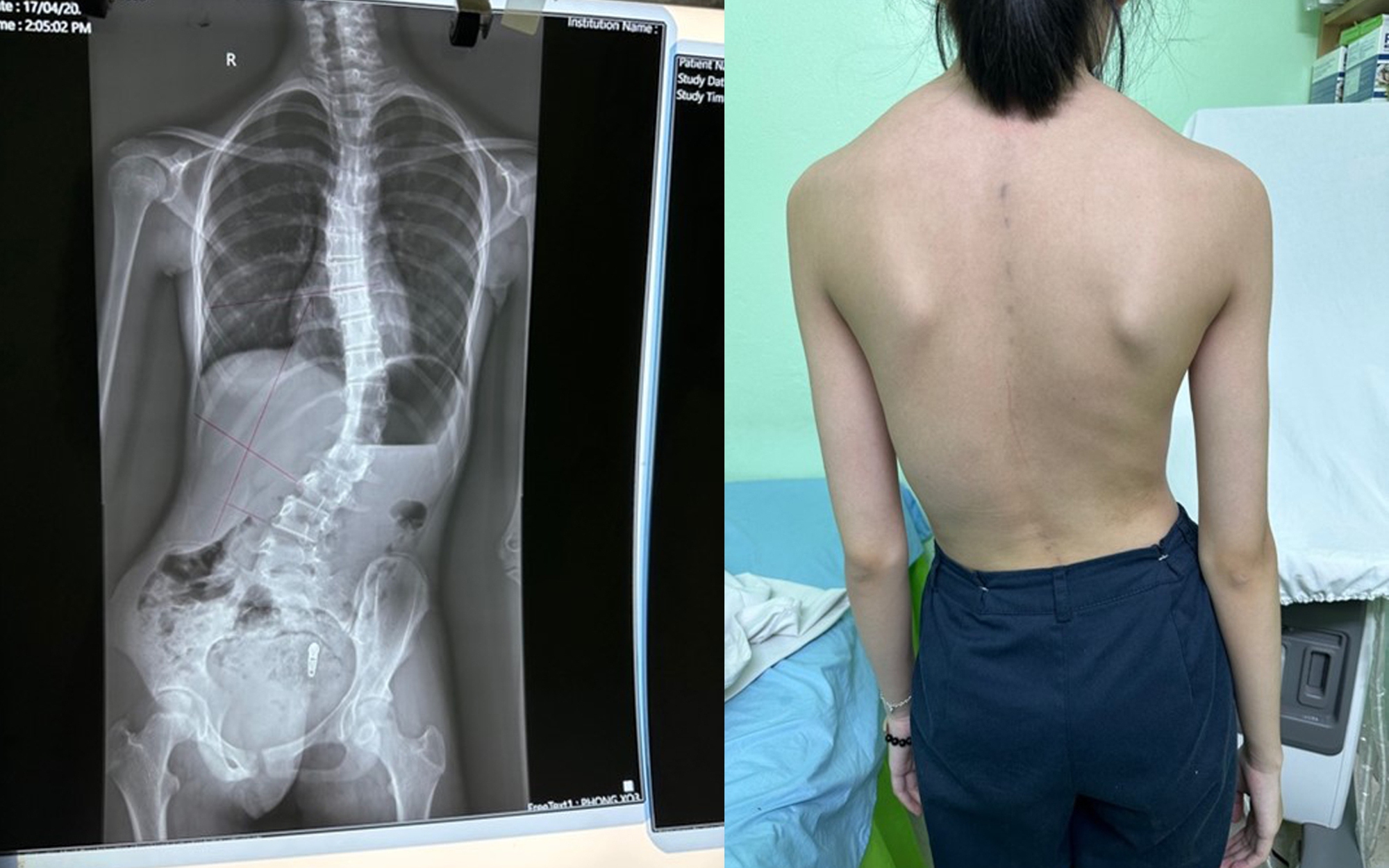 Đau cổ, đau lưng ở trẻ: Khi nào nghi ngờ cong vẹo cột sống?
