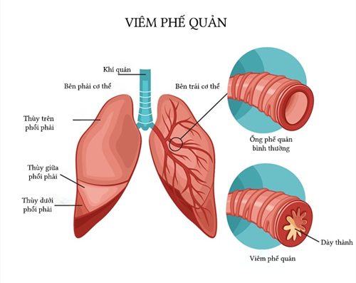 viem_phe_quan_benhvn