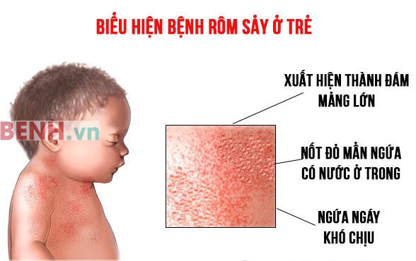 bieu-hien-rom-say-tre-em