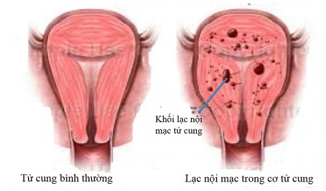 Lạc nội mạc tử cung ảnh hưởng đến chu kỳ kinh nguyệt như thế nào? - Ảnh 2.